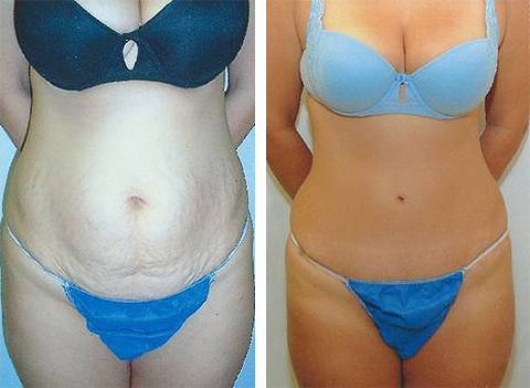 tummy tuck patient photos