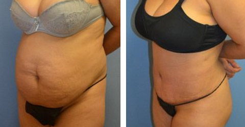 Abdominoplasty  Best Tummy Tuck Results New York