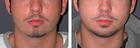 Buccal Fat Pad Removal (Cheek Fat Removal) - Heavenly Plastic Surgery