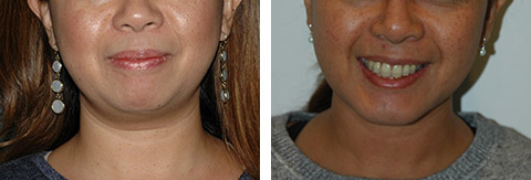 What You Need to Know About Buccal Fat Removal - Dr. Pancholi