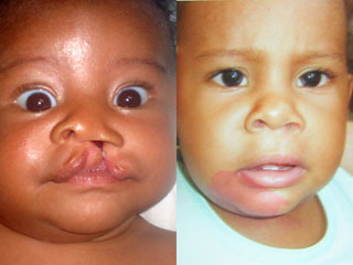 Cleft Lip and Cleft Palate Before and After Photo