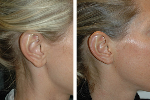 Earlobe Repair - The Complete Awesome Guide with Tips and