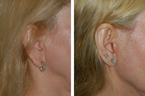 Earlobe Reduction Surgery