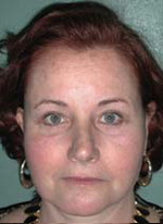 Endoscopic Brow Lift - Patient 3 - Front - After