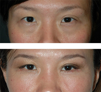 eyelid surgery nyc