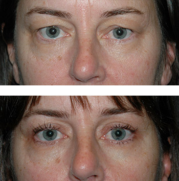 eyelid surgery nyc