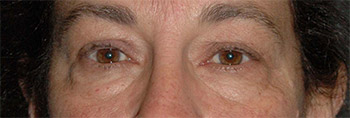 eyelift surgery new york