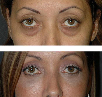 lower eyelid bag removal