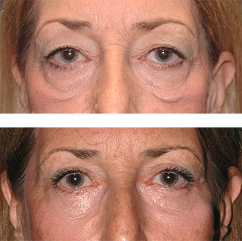 lower lid festoon blepharoplasty