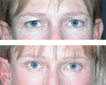 upper and lower blepharoplasty photos