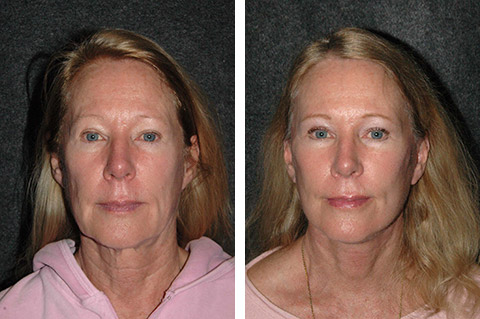 best deep plane facelift surgery results