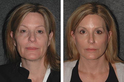 Vertical Facelift Patient Before and After Side View