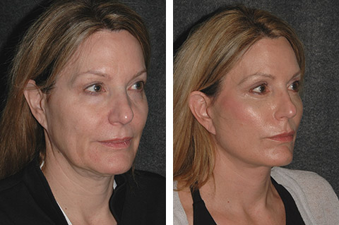 Vertical Facelift Patient Before and After Front View