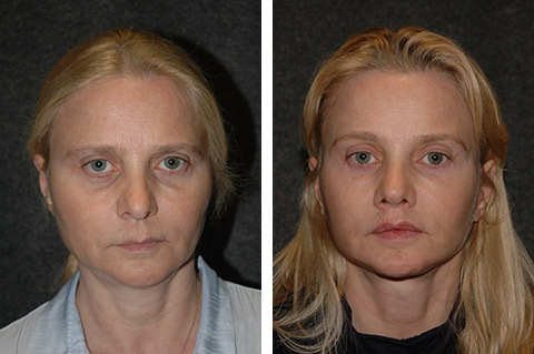 deep plane facelift before after deep plane facelift before after