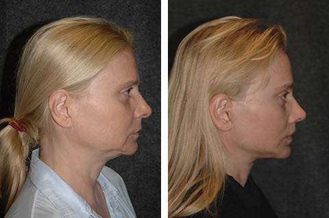 deep plane facelift before after deep plane facelift before after