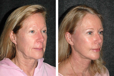 deep plane facelift patient results