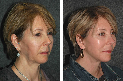 mini Facelift before and after patient 28 | Lifted cheeks, defined jawline, firm neck | New York Facial Plastic Surgery