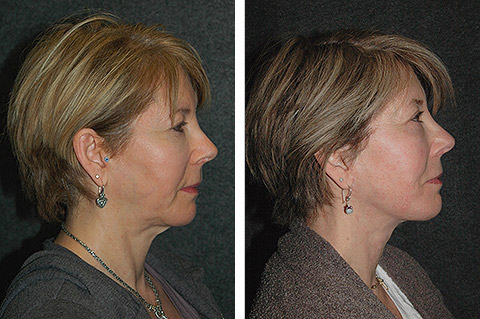 mini Facelift before and after patient 28 | Lifted cheeks, defined jawline, firm neck | New York Facial Plastic Surgery