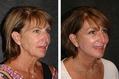 facelift before and after facelift before and after