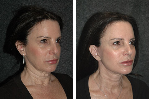 facelift necklift new york facelift necklift new york