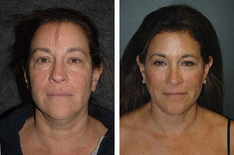 facelift surgery before after photos nyc