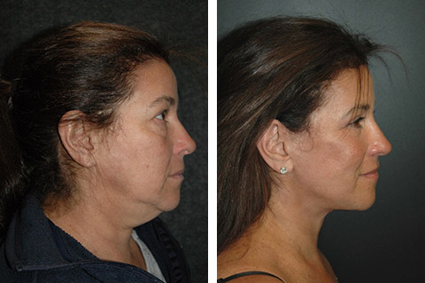 Facts About Best Facelift Surgeon Austin Uncovered