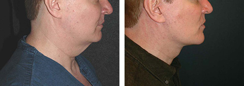 male facelift before and after patient