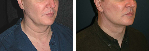 male facelift before and after patient