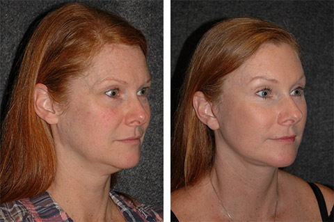 mini facelift before & after photos