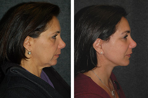 Mini Facelift Before and After Mini Facelift Before and After