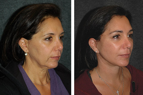 Mini Facelift Before and After Mini Facelift Before and After