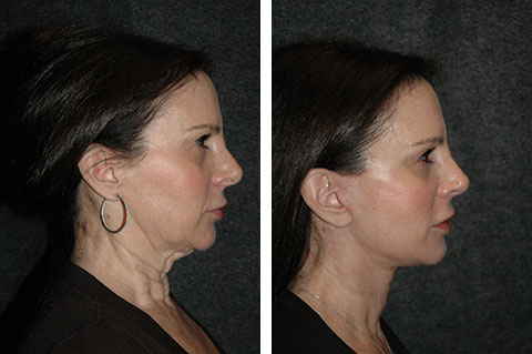 new york face and neck lift new york face and neck lift