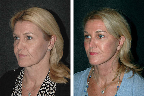 new york facelift patient before and after photos new york facelift patient before and after photos