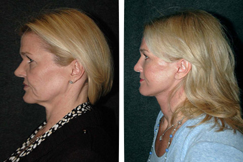 new york top facelift surgeon new york top facelift surgeon