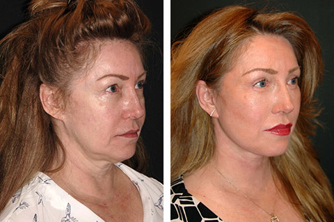 smas facelift before and after smas facelift before and after