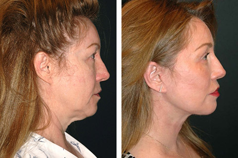smas facelift before and after smas facelift before and after