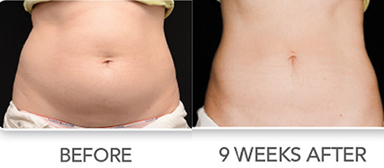 Coolsculpting Freeze the Fat Before and After Photo