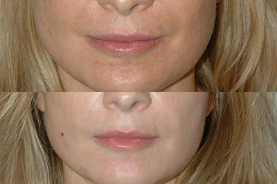 Lip Lift Before and After