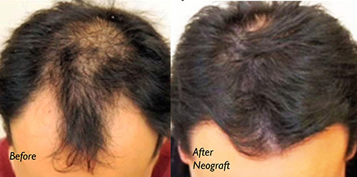 NEOGRAFT HAIR TRANSPLANT - Patient 3