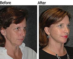 FACELIFT SURGEON | NYC FACELIFT SURGEON | NYC