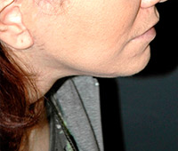 Facelift after weight loss - Patient 1 - Lateral Right - After