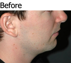 Jaw Implant Photos - Patient 1 - Before