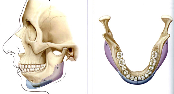 Jaw Implant Diagram