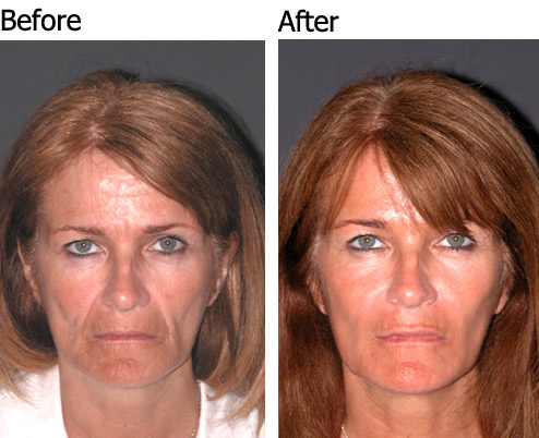 Liquid Face lift - Patient 1