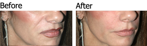 Liquid Face lift - Patient 2