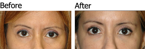 non surgical eye lift