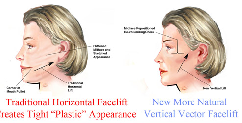 Vertical Facelift Surgery in NY Vertical Facelift Surgery in NY