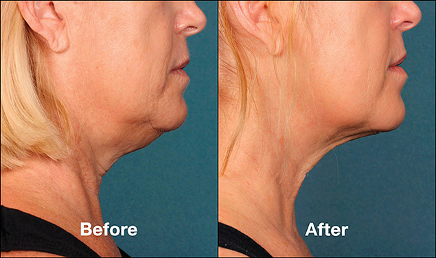 Kybella Injections Double Chin Removal