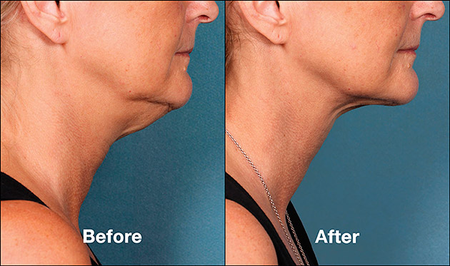 TightSculpting, Neck laxity, Non-surgical neck lift