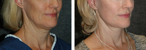 best lower facelift patient photos